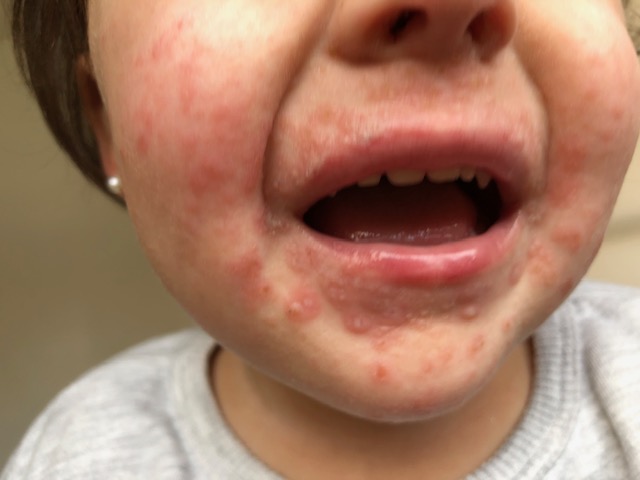 Lesiones periorales y en labios