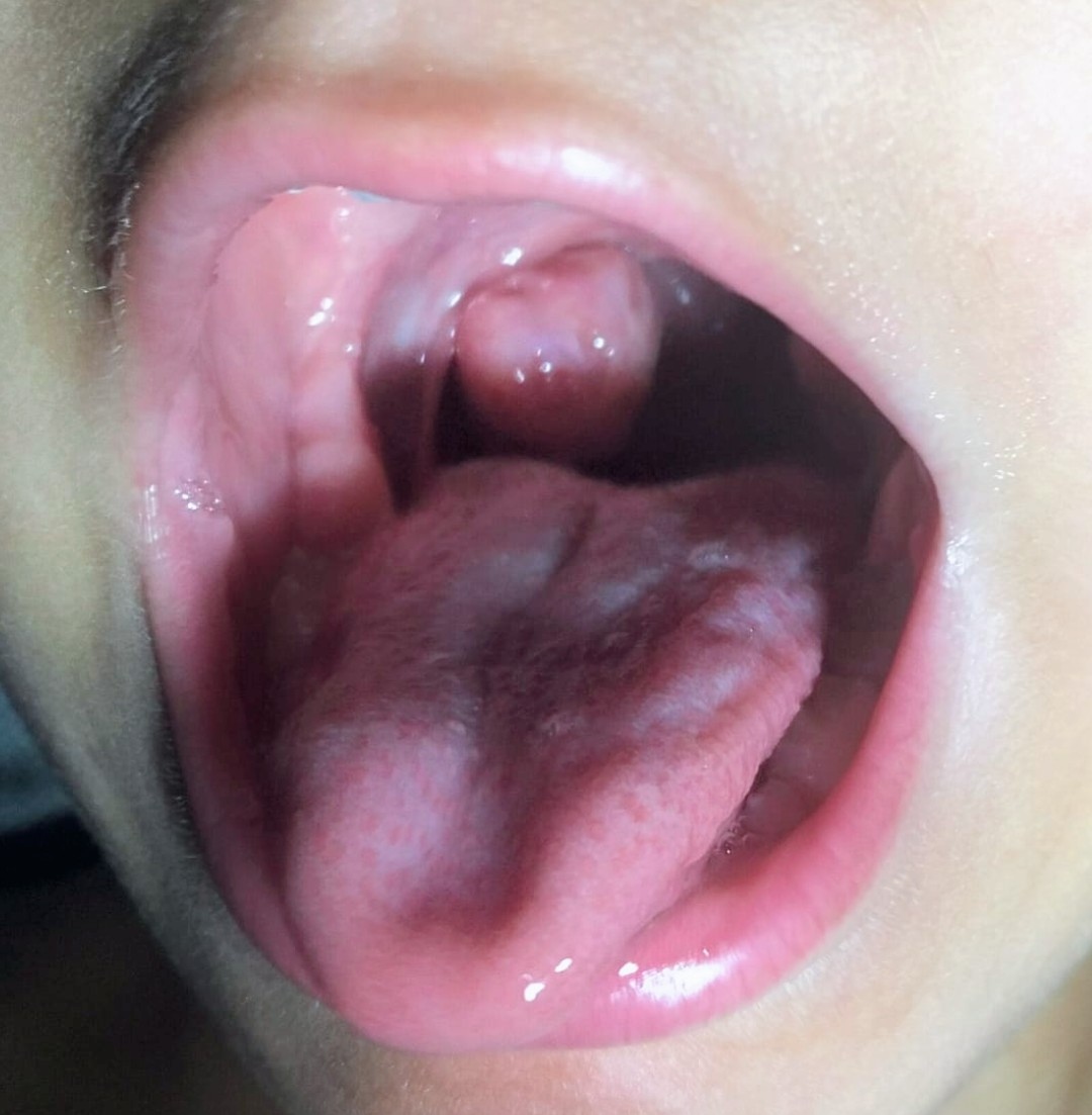 Hipertrofia amigdalar unilateral